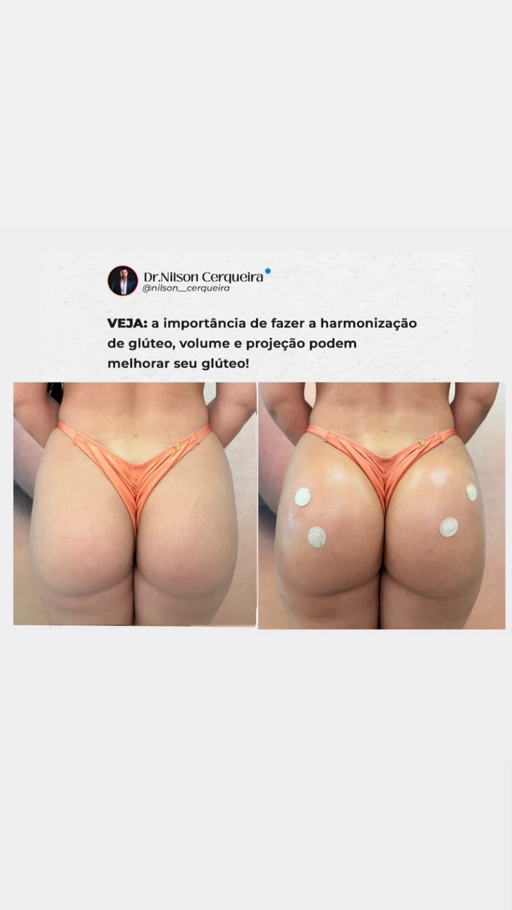 Resultado clínico de harmonização glútea — caso 1