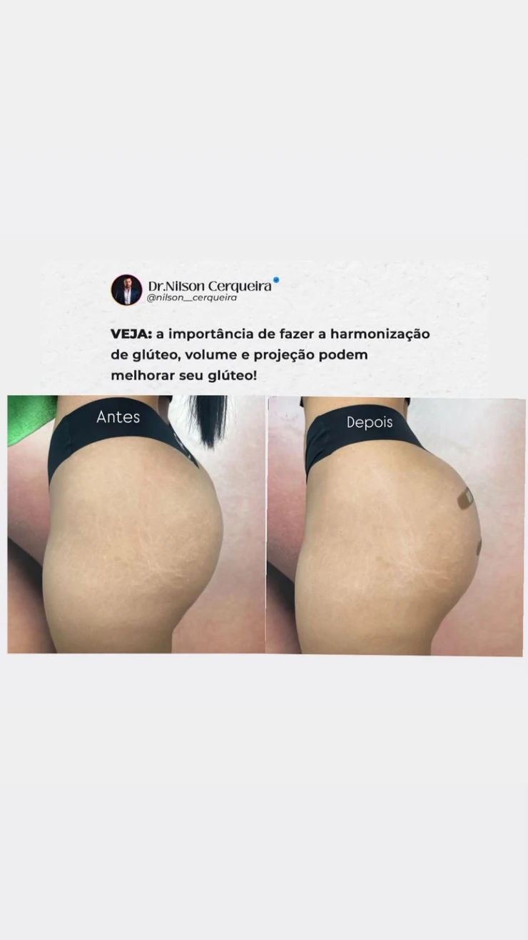 Resultado clínico de harmonização glútea — caso 2