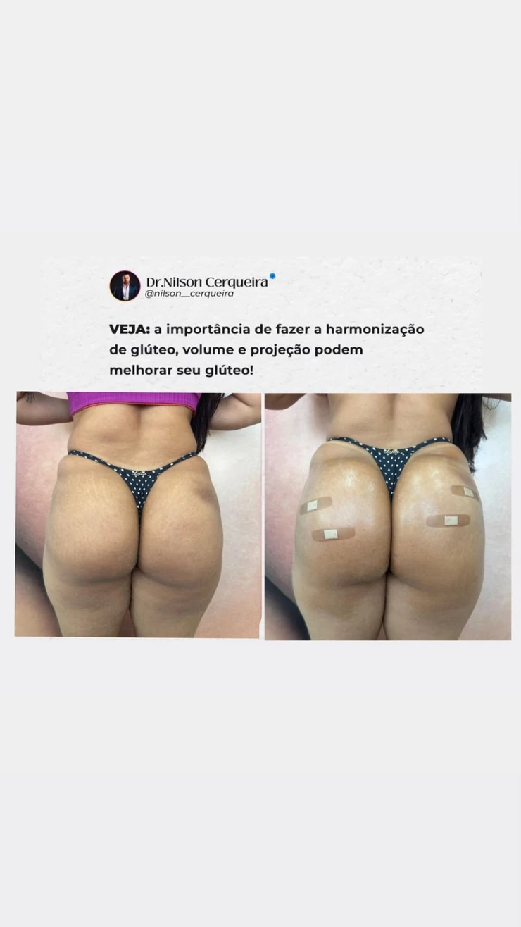 Resultado clínico de harmonização glútea — caso 3