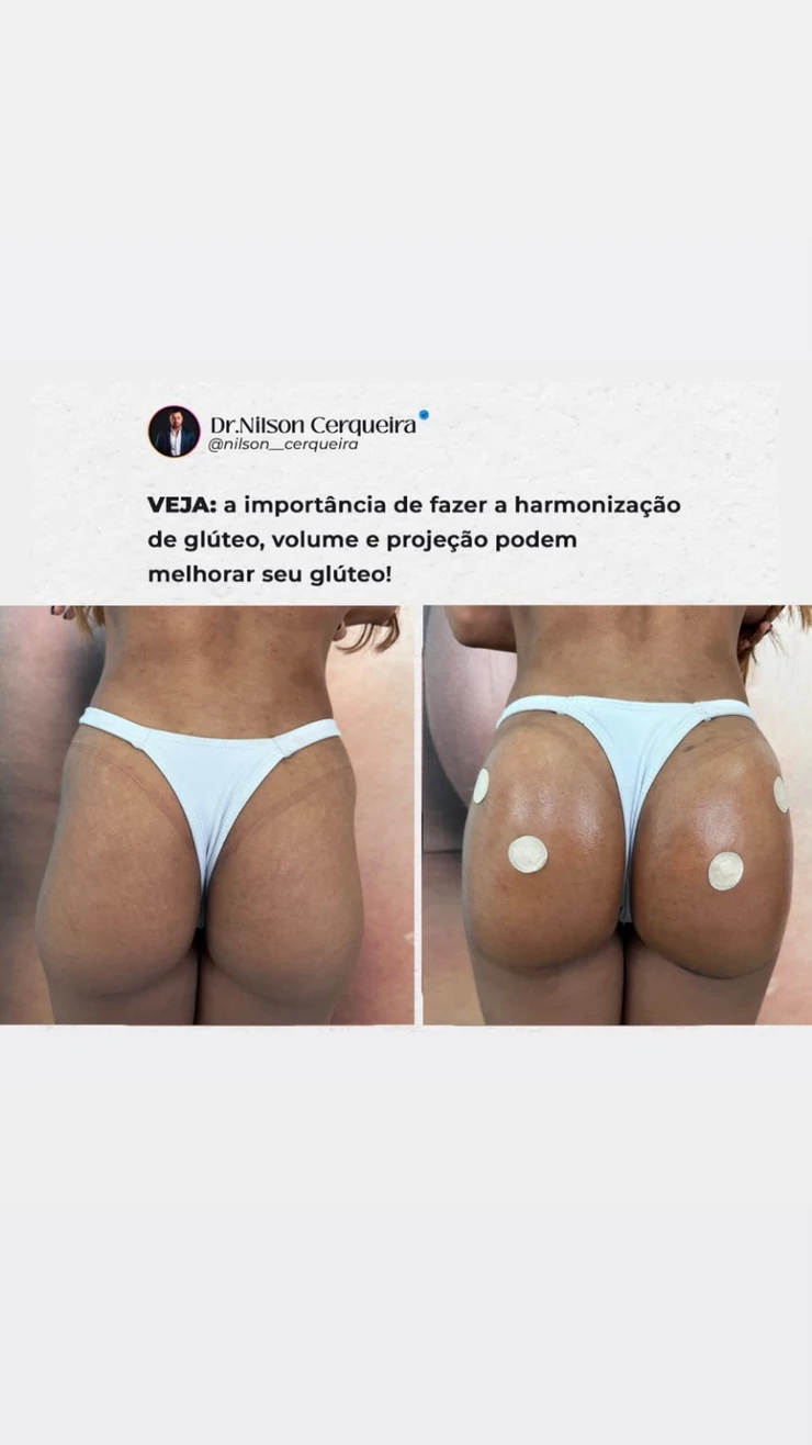 Resultado clínico de harmonização glútea — caso 4